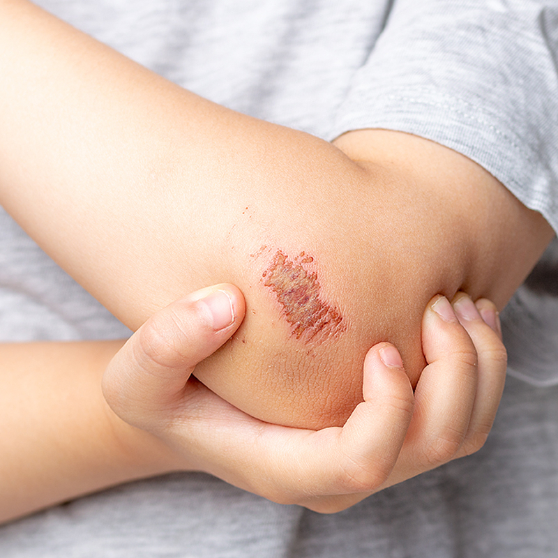 Comment cicatriser une peau abimée & enlever une cicatrice