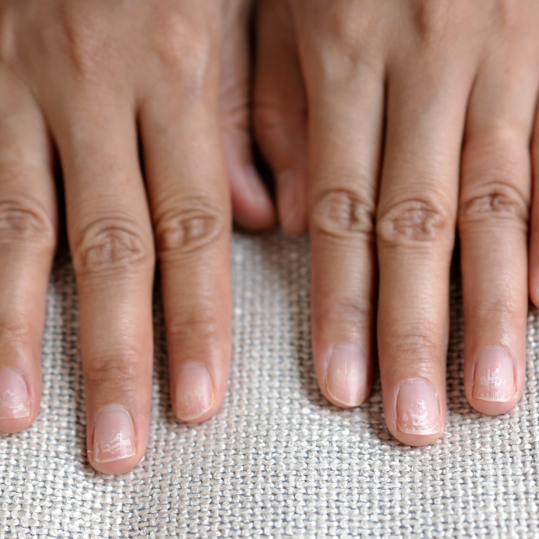 Gerçures & crevasses des mains abîmées : causes et soin