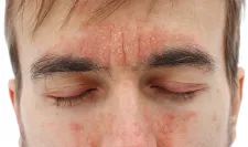 Un homme avec un psoriasis