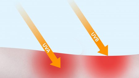 Graphique montrant un coup de soleil