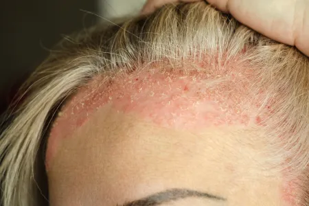 Un psoriasis au niveau des cheveux