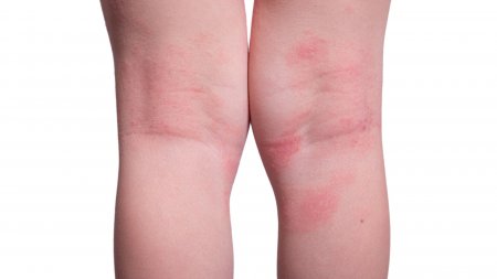 eczéma jambes enfant