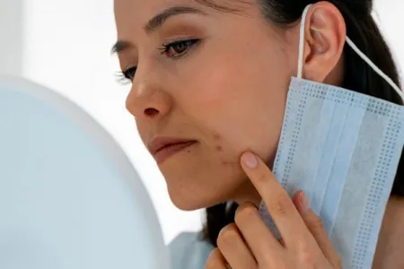 Femme présentant de l'acné en portant son masque