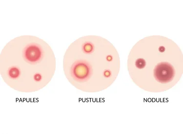 papules pustules nodules